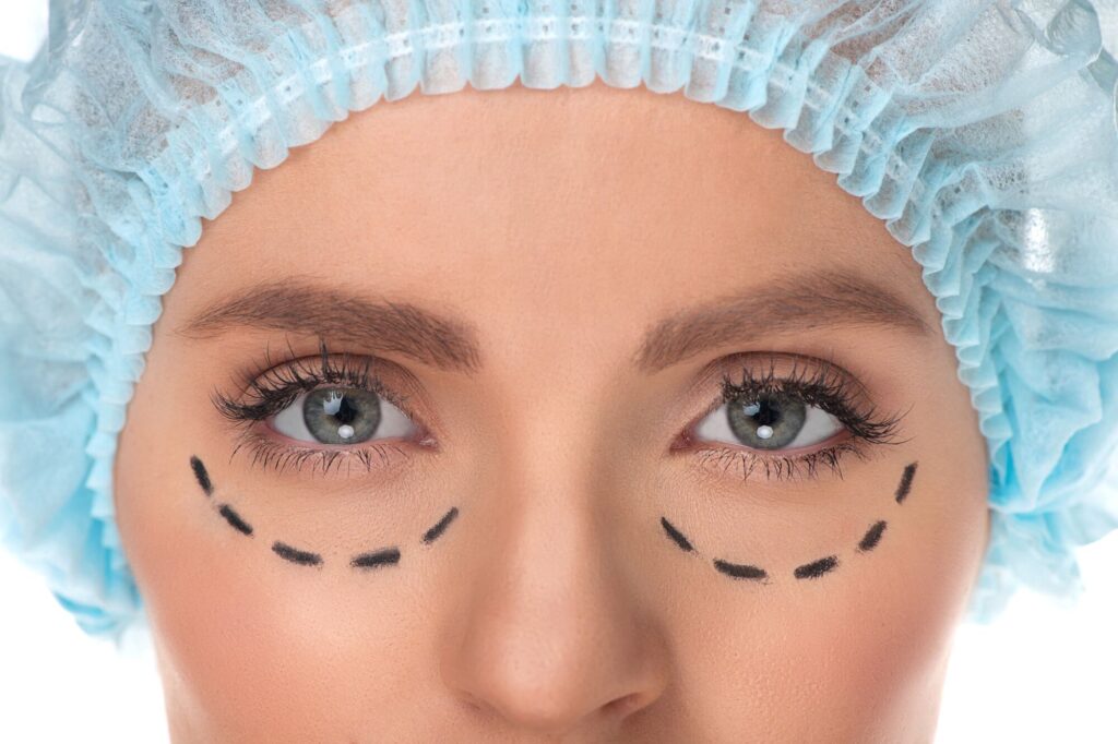Blépharoplastie à Paris, tracé de chirurgie des paupières