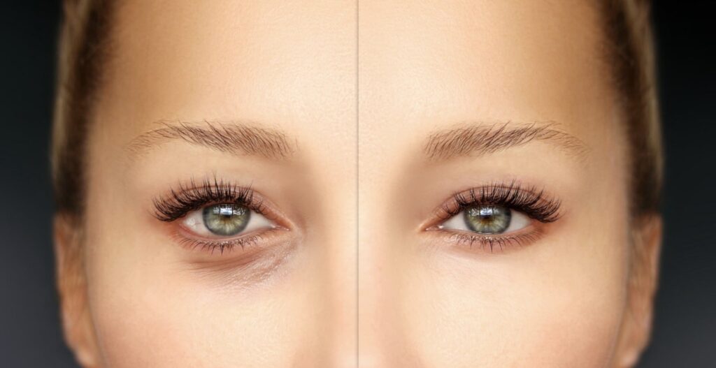 Blépharoplastie inférieure - chirurgie des paupières inférieures à Paris
