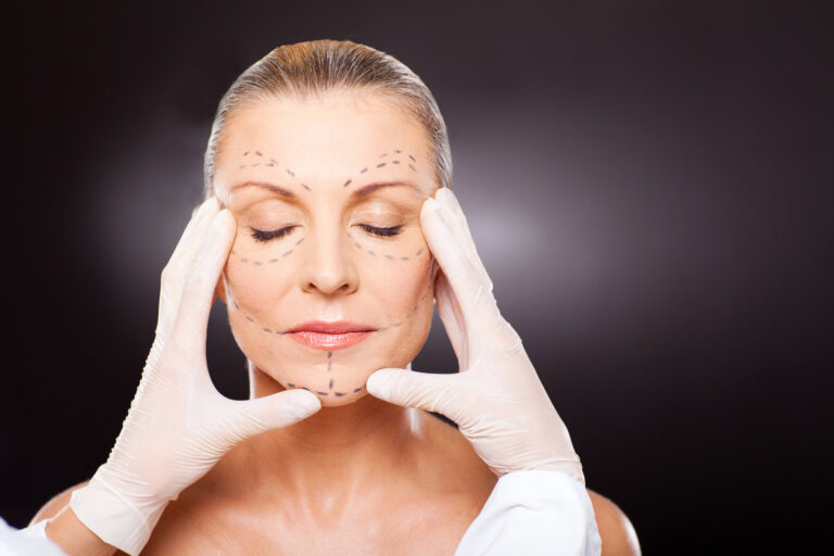Lifting du visage à Paris, tracé préopératoire du lifting cervico-facial 1er