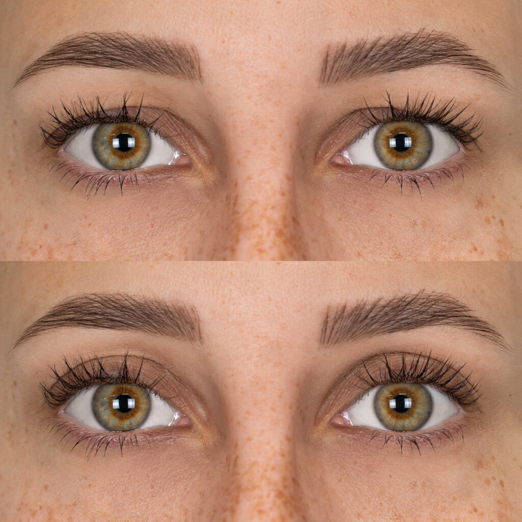 Le lifting des paupières est une technique de chirurgie esthétique du visage visant à corriger la chute des paupières liée au vieillissement.